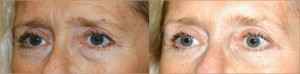 Upper and Lower Lid Blepharoplasty with Botox