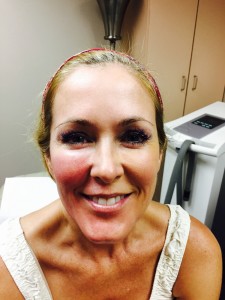 Post treatment with our new Oxygenetix Foundation on left side of face.