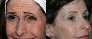 Dr. Olson treated full face with Botox