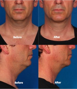 Male neck treatment with Kybella