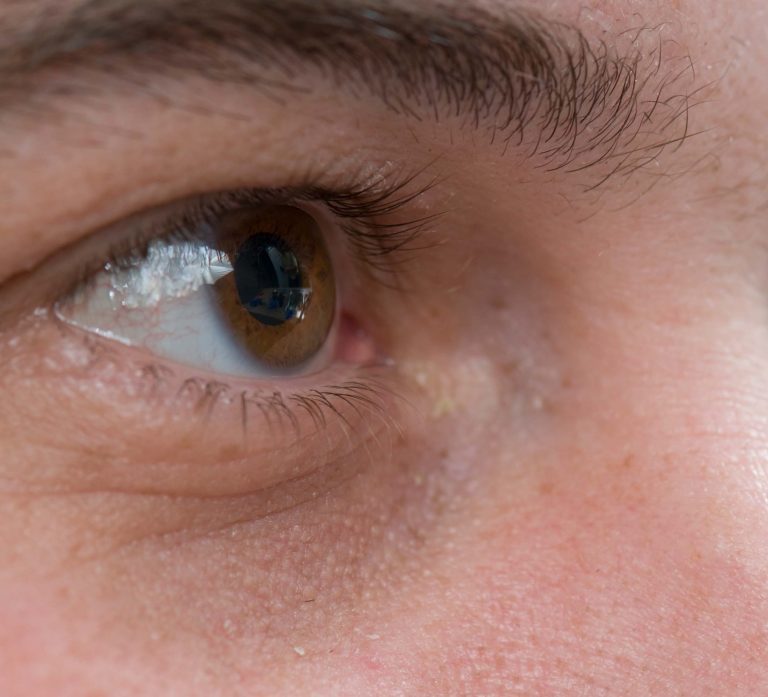 Blepharoplasty Eyelid Lift for Men